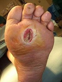 diabetic-foot-ulcer